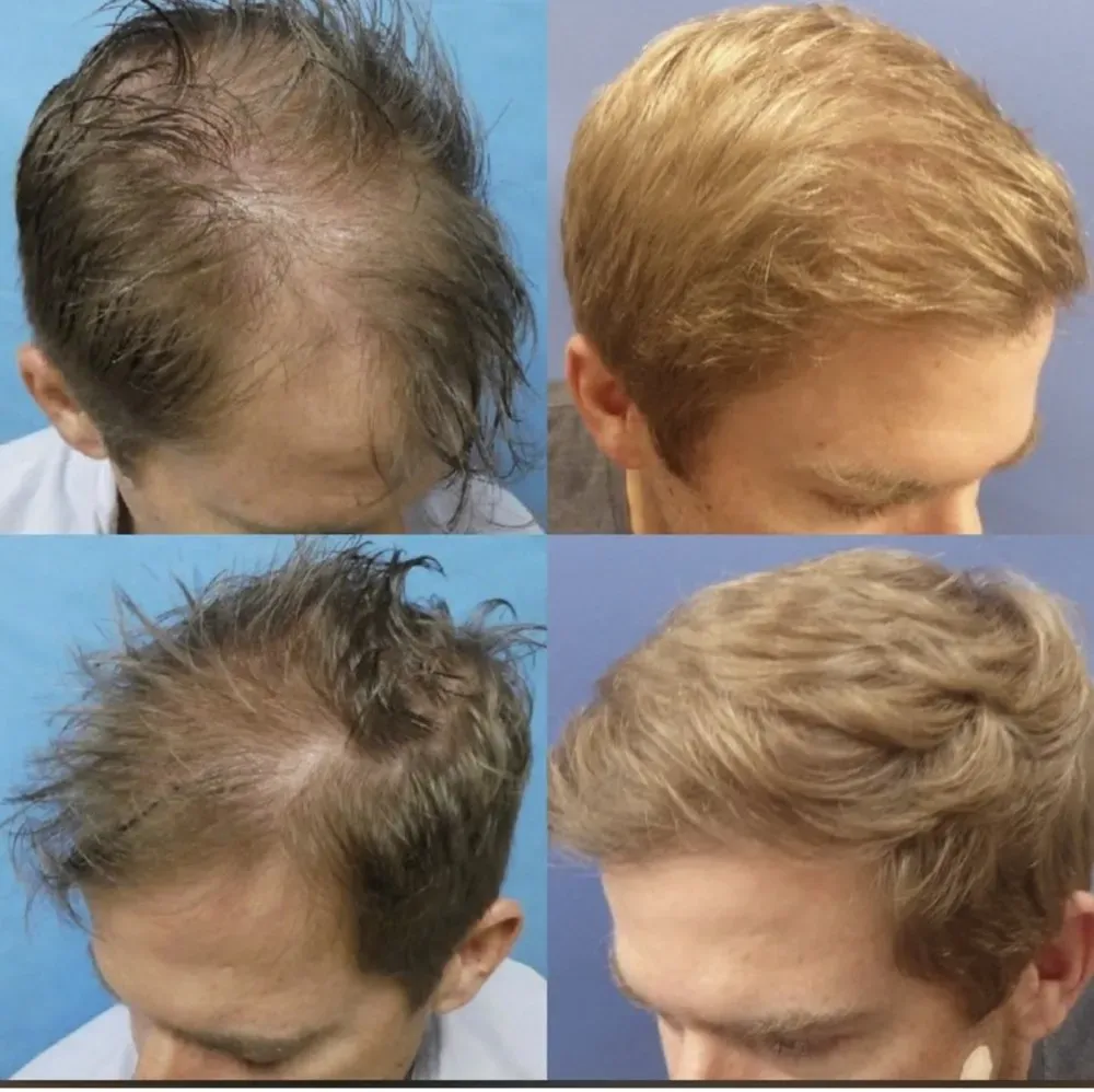 Hair loss treatment